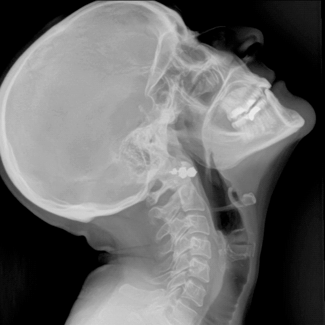 DDR-CSpine-2020-03-27-(1).gif DDR-CSpine-2020-03-27-(1).gif